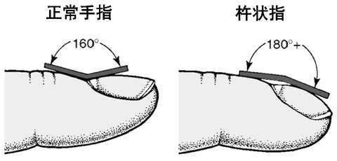 手指出现4种异样，当心是大病来临
